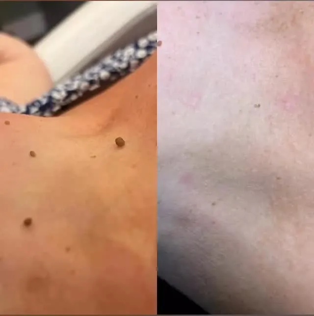 Example treatment result card